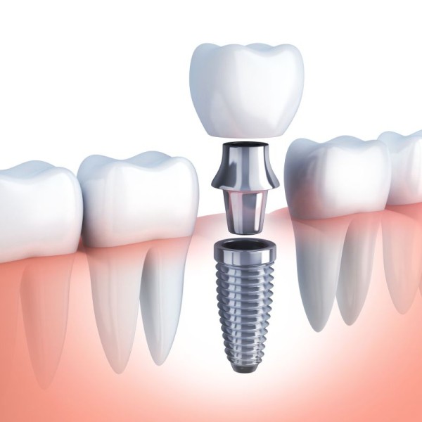 Dental Implants in Varna – Reliable and Long-Term Solution